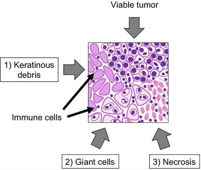 Frontiers | Immunotherapy For Head And Neck Cancer: A Paradigm Shift ...